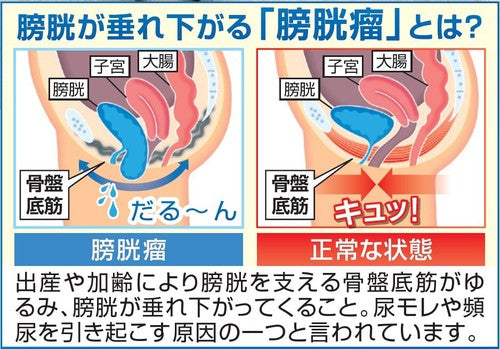 骨盤底筋ベルト モレナレディ Mサイズ Lサイズ 膀胱引き締め 尿もれ対策 膀胱加圧パッド 下着の上に着けるだけ(代引不可)