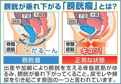 2枚組 骨盤底筋ベルト モレナレディ Mサイズ Lサイズ 膀胱引き締め 尿もれ対策 膀胱加圧パッド 下着の上に着けるだけ(代引不可)